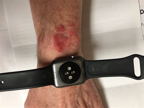 apple watch hautirritationen|apple watch skin irritation.